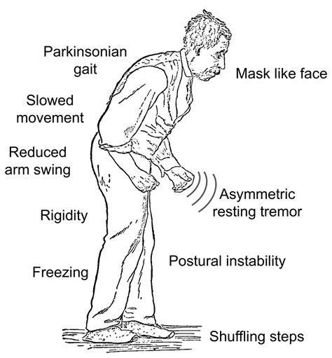 parkinson's early symptoms nhs